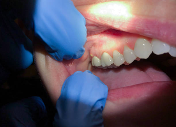 Best Emergency Dentist for Lost Fillings or Crowns in Woodlawn Beach, FL